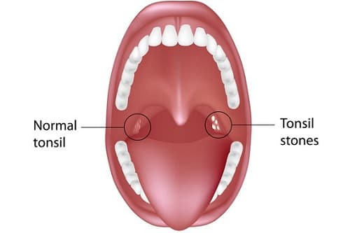 Tonsil Stones