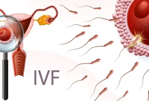 ivf