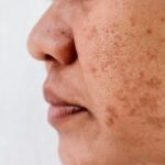 Pigmentation